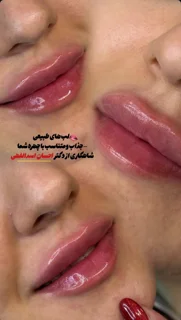فیلر لب