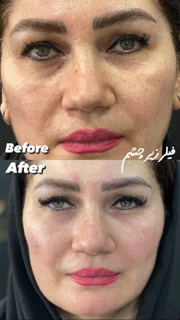 زیر چشم