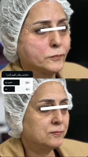 لیفت با نخ
